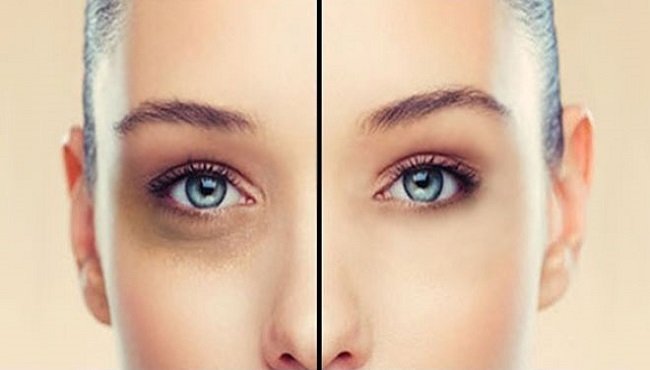 Occhiaie e borse sotto gli occhi: come eliminarle con i rimedi naturali
