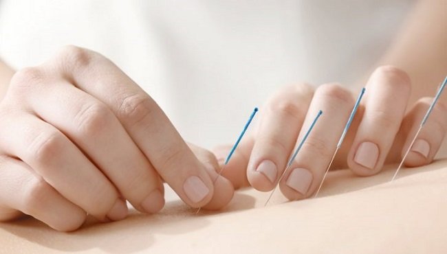 Agopuntura: come funziona e controindicazioni