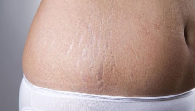 Prevenire le smagliature: rimedi naturali per elasticizzare la pelle