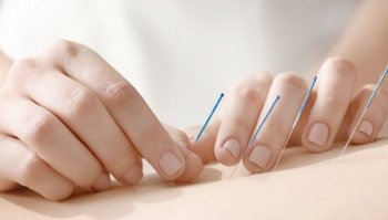 Agopuntura: come funziona e controindicazioni